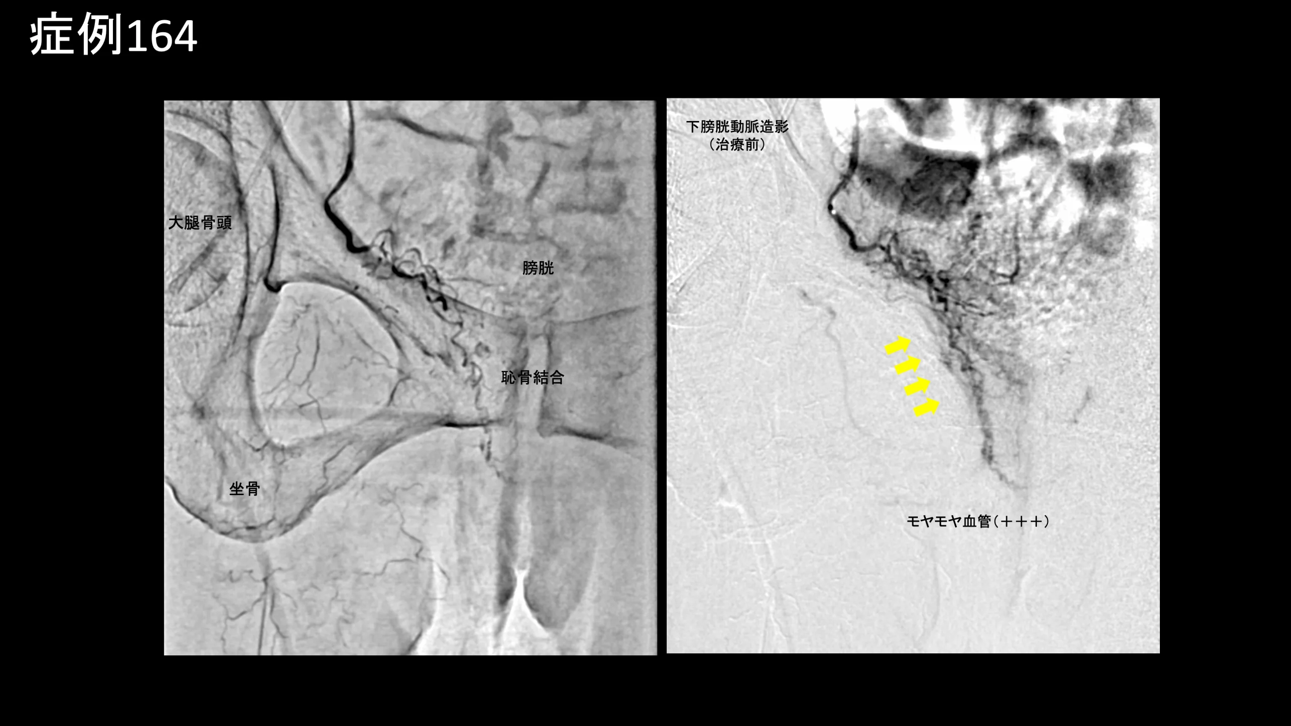 MRI まんこ 誘発性膣前庭炎に対するモヤモヤ血管治療